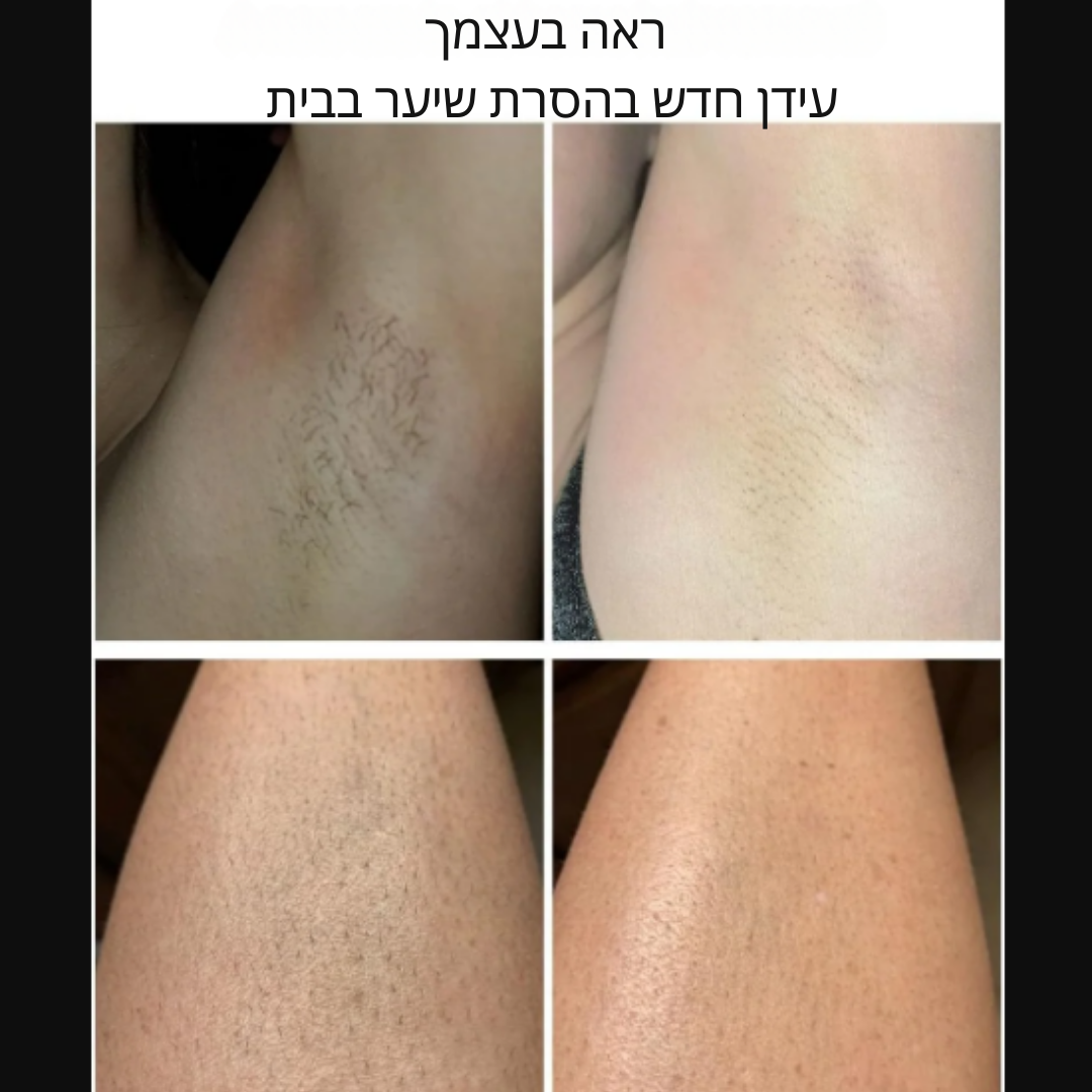 ™Lumiro | לייזר IPL – טכנולוגיית קירור פטנט, הסרת שיער לכל הגוף